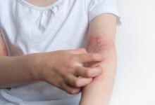 eczema specialist uk