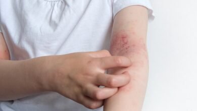 eczema specialist uk