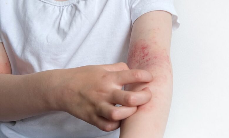 eczema specialist uk