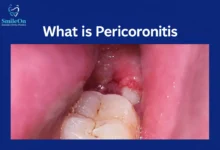 can pericoronitis kill you