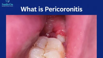 can pericoronitis kill you