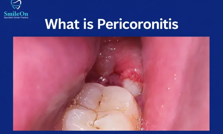 can pericoronitis kill you